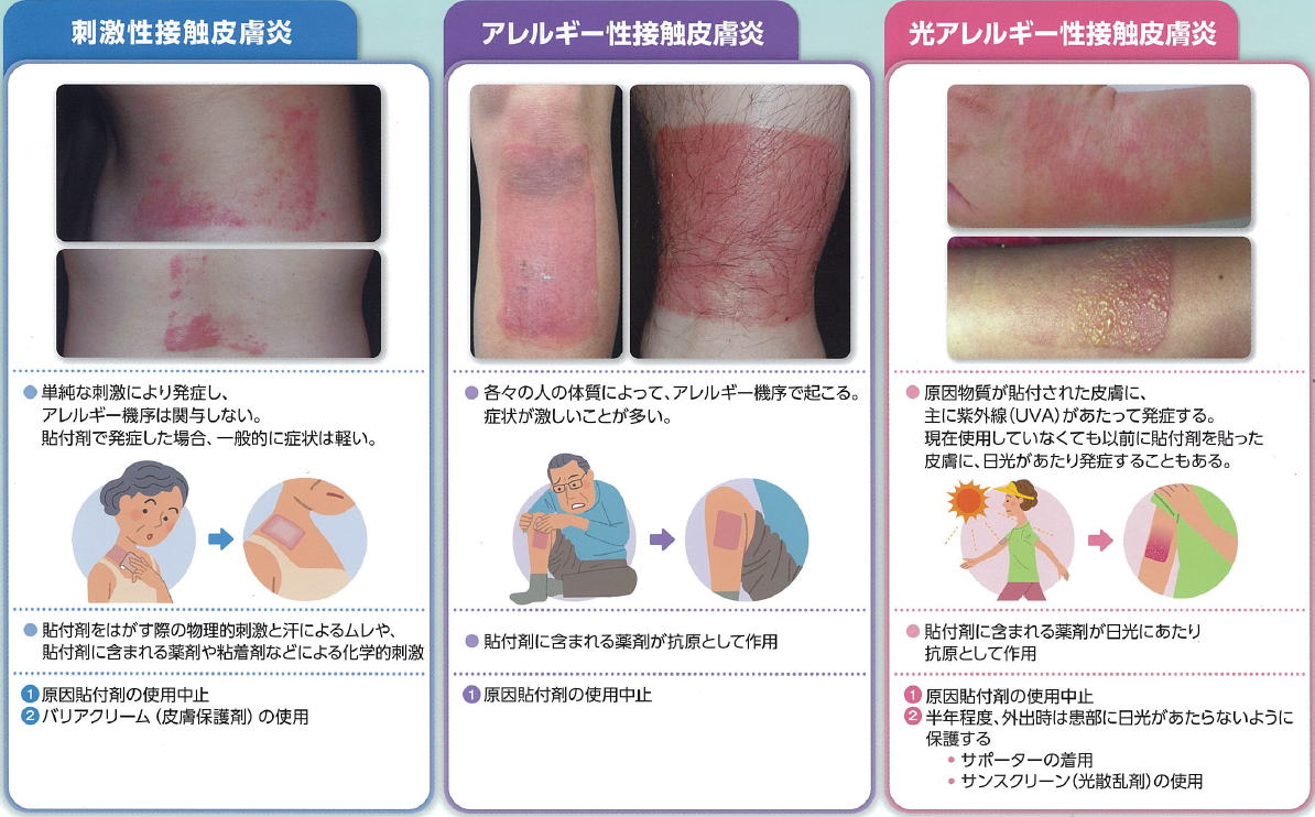 Contact_Dermatitis.jpg